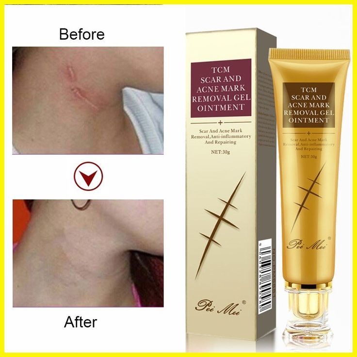 Creme Removedor de Cicatrizes , Acne e Manchas